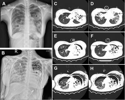 Severe influenza A virus pneumonia complicated with Curvularia lunata infection: Case Report